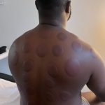 Séance cupping chez K-Therapie