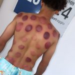 Séance cupping chez K-Therapie