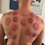 Séance cupping chez K-Therapie