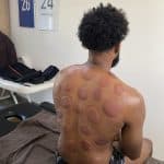 Séance cupping chez K-Therapie
