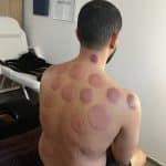Séance cupping chez K-Therapie
