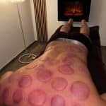 Séance cupping chez K-Therapie