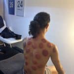 Séance cupping chez K-Therapie
