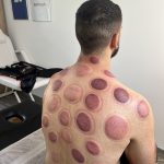 Séance cupping chez K-Therapie