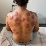 Séance cupping chez K-Therapie