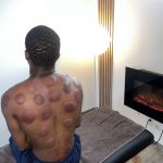 Séance cupping chez K-Therapie