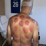 Séance cupping chez K-Therapie