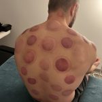 Séance cupping chez K-Therapie