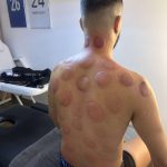 Séance cupping chez K-Therapie