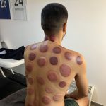 Séance cupping chez K-Therapie