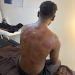 Séance cupping chez K-Therapie