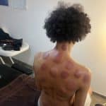 Séance cupping chez K-Therapie