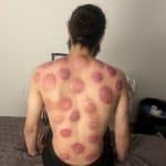 Séance cupping chez K-Therapie