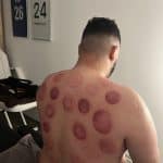 Séance cupping chez K-Therapie