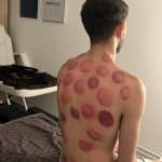 Séance cupping chez K-Therapie