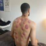 Séance cupping chez K-Therapie