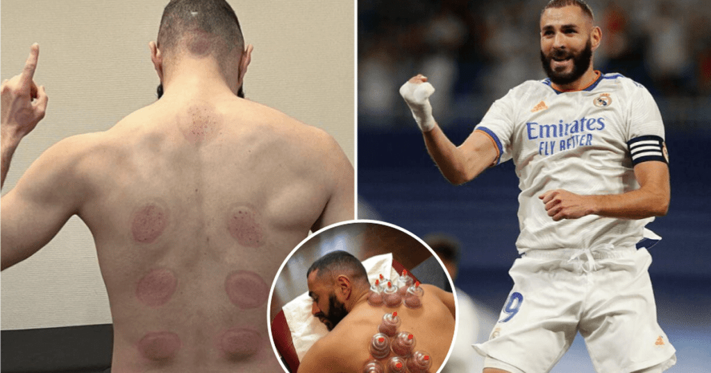 Le sportif ballon d'or Karim Benzema pratique le cupping