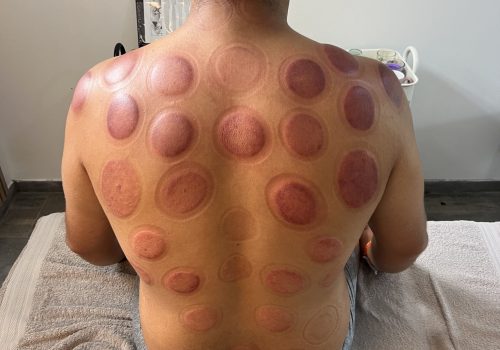 Cupping Séance cupping chez K-Therapie